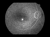 Central Serous Retinopathy