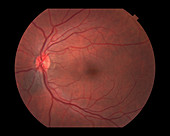 Choroidal Nevus