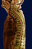 Lumbar Compression Fracture,MRI