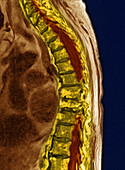 Thoracic Compression Fracture,MRI