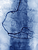 Right Coronary Artery