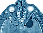 Neuroma,MRI