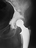 Hip Replacement,X-ray