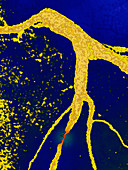 Myocardial Infarction,Angiogram