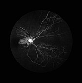 Central Retinal Artery Occlusion