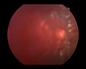 Proliferative Diabetic Retinopathy