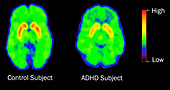 ADHD Levels of Dopamine,PET