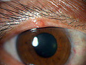 Conjunctival Cyst