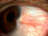 Pterygium