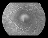 Central Serous Retinopathy