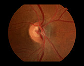 Optic Nerve Melanoma