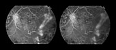 Proliferative Diabetic Retinopathy