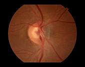 Optic Nerve Melanoma