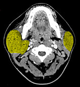 Enhanced Benign Lesions of AIDS