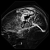 Cerebral Angiogram of AVM
