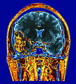Enhanced Temporal Lobe AVM on MRI