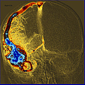 Enhanced Temporal Lobe AVM on Angiography