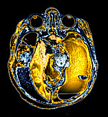 Enhanced Extensive Birth Injury MRI