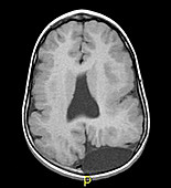 Congenital Brain Malformations on MRI