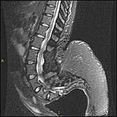 Lumbar Spine MRI in Achondroplastic Dwarf