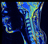 MRI of Severe Chiari I Malformation