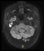 Cholesteatoma of Temporal Bone