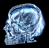 Enhanced 3D CT of Craniotomy