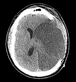 Large Acute Stroke with Craniotomy