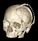 Decompressive Craniotomy for Stroke