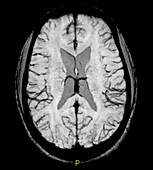 Susceptibility Weighted MR Image of Brain