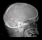 Skull Fracture on X-Ray
