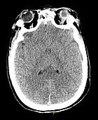 Severe Traumatic Brain Injury,CT Scan
