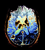 Intracerebral Haemorrhages,MRI