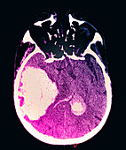 Massive Intracranial Hemorrhage,CT Scan