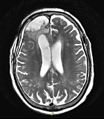 Post Operative MRI for GBM