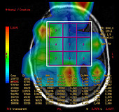 Post Operative MR Spectroscopy for GBM