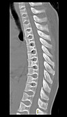 Sickle Cell Osteopathy,CT Scan