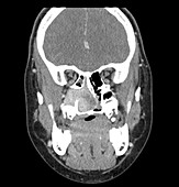 Nasopharyngeal Angiofibroma,CT Scan