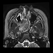 Juvenile Nasopharyngeal Angiofibroma,MRI