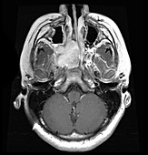 Juvenile Nasopharyngeal Angiofibroma,MRI