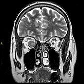 Optic Sheath Meningioma,MRI