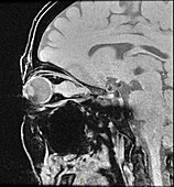 Optic Sheath Meningioma,MRI