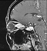 Optic Sheath Meningioma,MRI