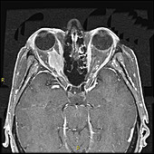 Optic Sheath Meningioma,MRI