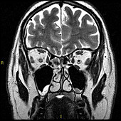 Optic Neuritis,MRI