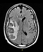 Haemorrhagic Cerebral Infarct,MRI