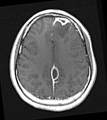 Sinusitis Complicated by Empyema,MRI