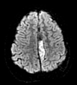 Sinusitis Complicated by Empyema,MRI