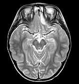Sinusitis with Empyema,MRI