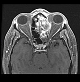 Squamous Cell Cancer of Ethmoids,MRI